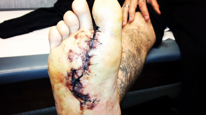 Le pied de Kyle Partridge